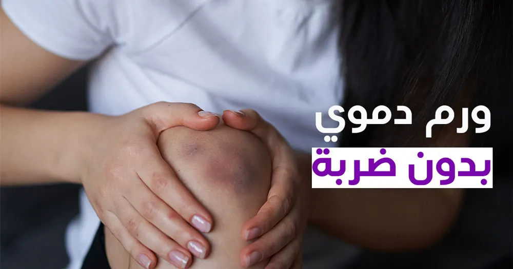 ورم دموي بدون ضربة